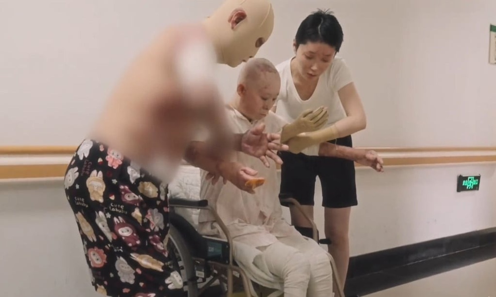 Bỏng nặng suýt mất tất cả, cựu mẫu gây sốt với nghề mới - 2